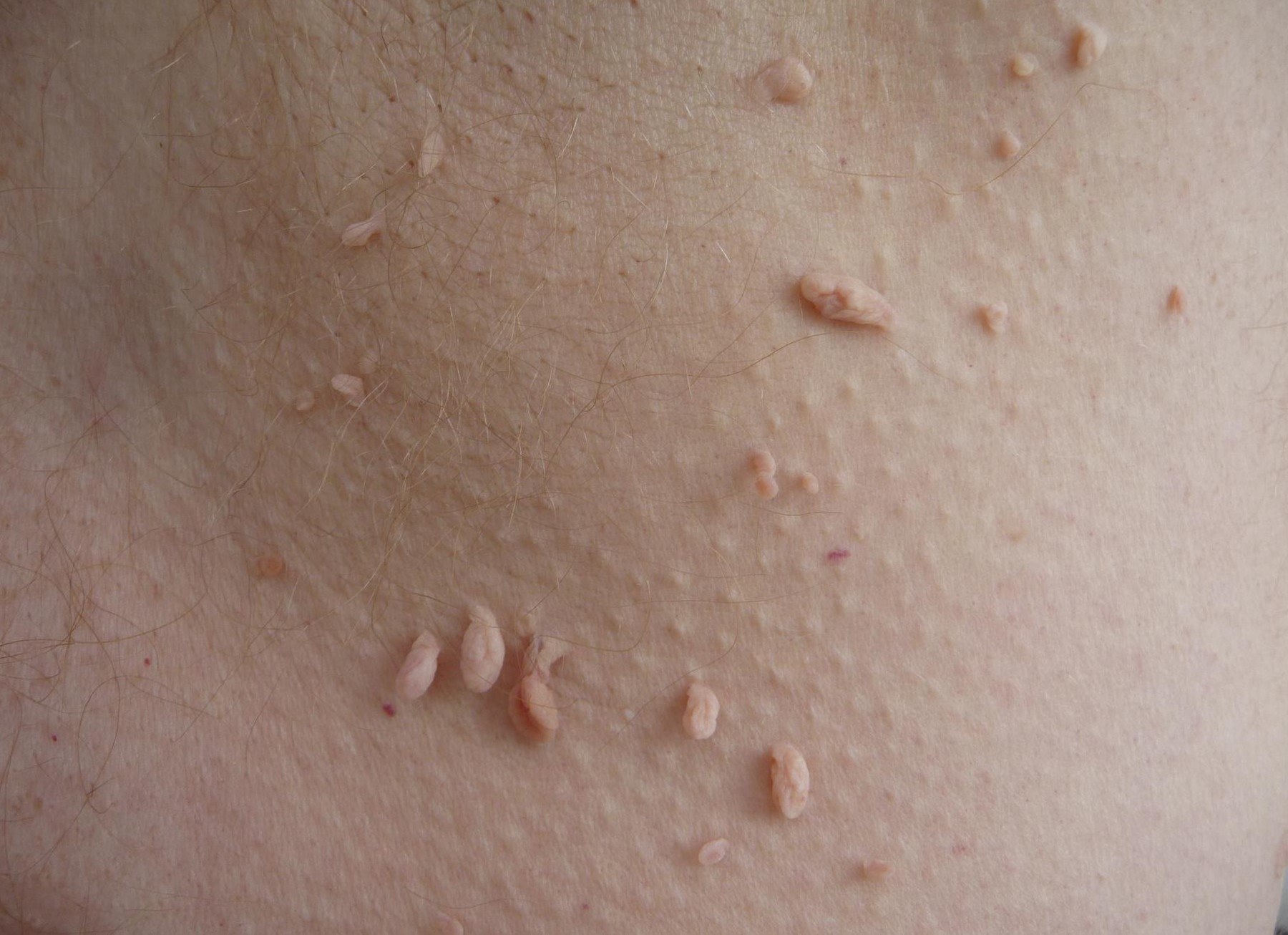 What Causes Skin Tags Healthcare Online